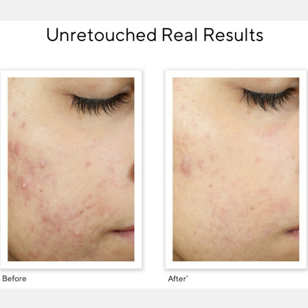 MURAD INVISISCAR RESURFACING TREATMENT. - Picture 3 of 6